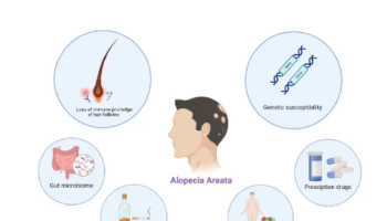Alopecia Areata - Diagnosis and treatment