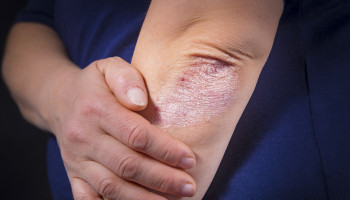 Beyond skin deep: addressing comorbidities in psoriasis