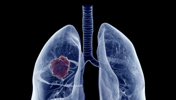 Lung cancer: progress with prognosis and the changing state of play
