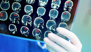 MJA Podcast: Advances in stroke medicine