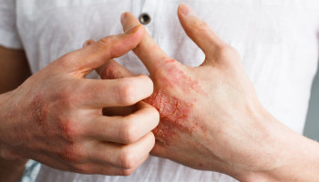 Eczema management in primary care