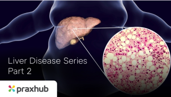 Liver Disease Series Part 2: Progressive liver disease in the community