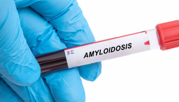 Systemic amyloidosis in a patient presenting with myopathy, peripheral oedema and proteinuria