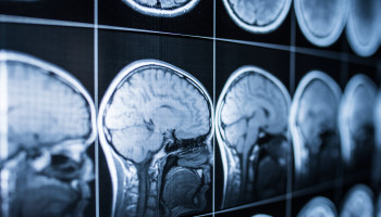 The Australian Traumatic Brain Injury National Data (ATBIND) project: a mixed methods study protocol