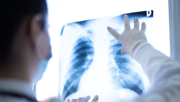 Lung cancer screening for Aboriginal and Torres Strait Islander peoples