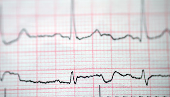 Cardiovascular risk management in the peri‐operative setting