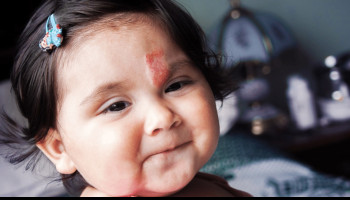 Hemangiomas and Vascular Malformations