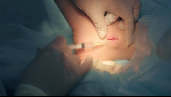 Painless Local anaesthesia and local Anaesthetic Blocks for Minor Surgery