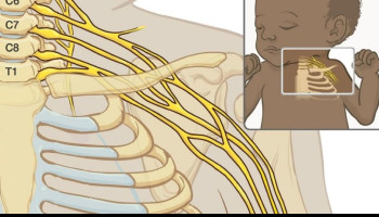 Brachial plexus birth palsy