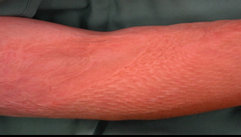 Principles of skin grafting