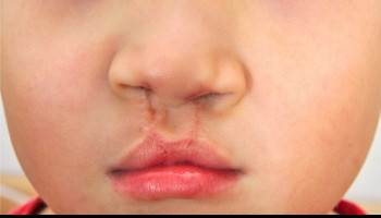 Craniofacial Conditions: Principles of Management