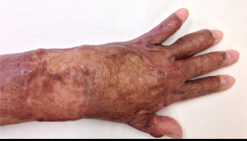 Burn Contracture, prevention and surgical management in limited resources setting