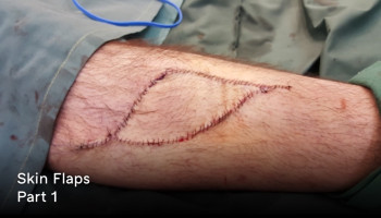 Part 1 Skin Flaps - Principles of Flap Repair