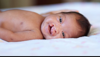 Administering Anaesthetic to Cleft Patients